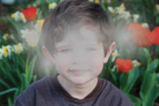 Blurry or dim vision from cataracts.