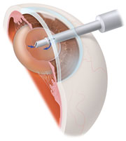 Phacoemulsification